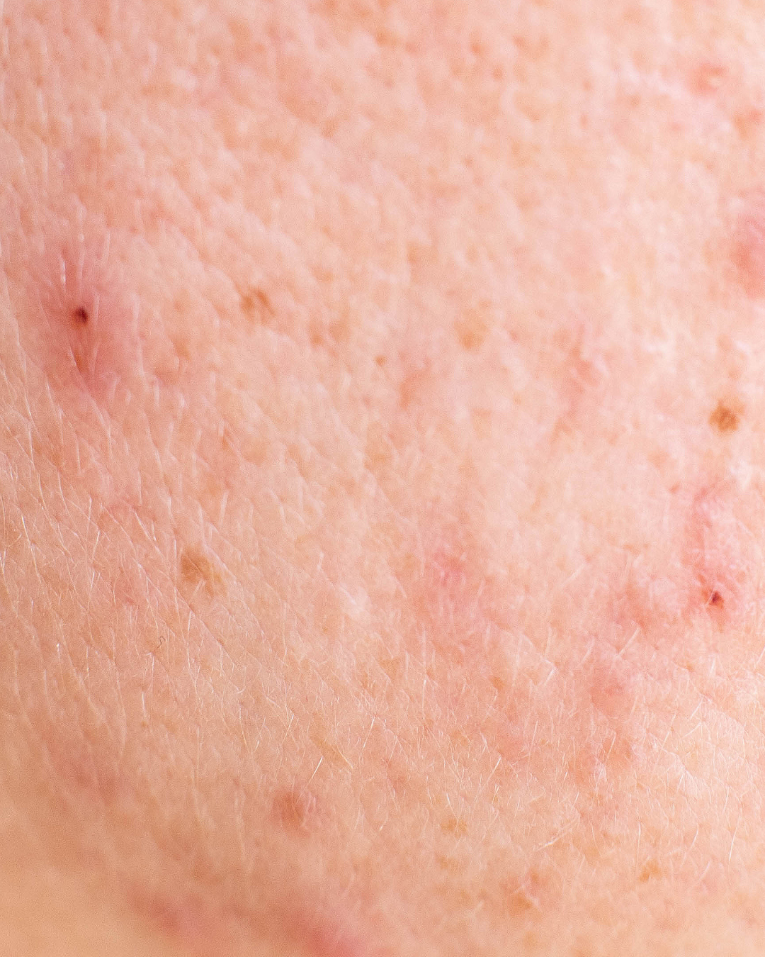 Acne-Prone Skin Treatment Guide