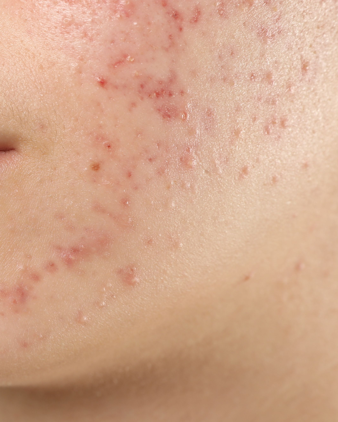 Esthetician for Acne in Surrey, BC