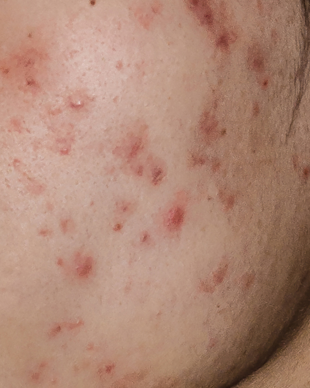 Best Treatments for Acne-Prone Skin