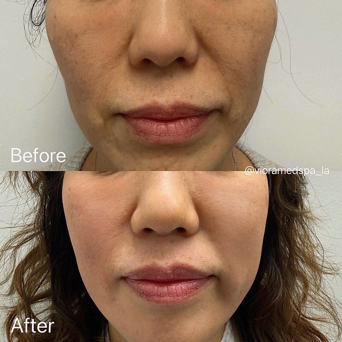 Before &amp; After ✨ This patient received Juvelook volume treatment along with facial T-shape contouring.

✨ Juvelook Benefits:
&bull; Restores lost volume naturally
&bull; Improves skin density and elasticity
&bull; Smooths fine lines and creates a