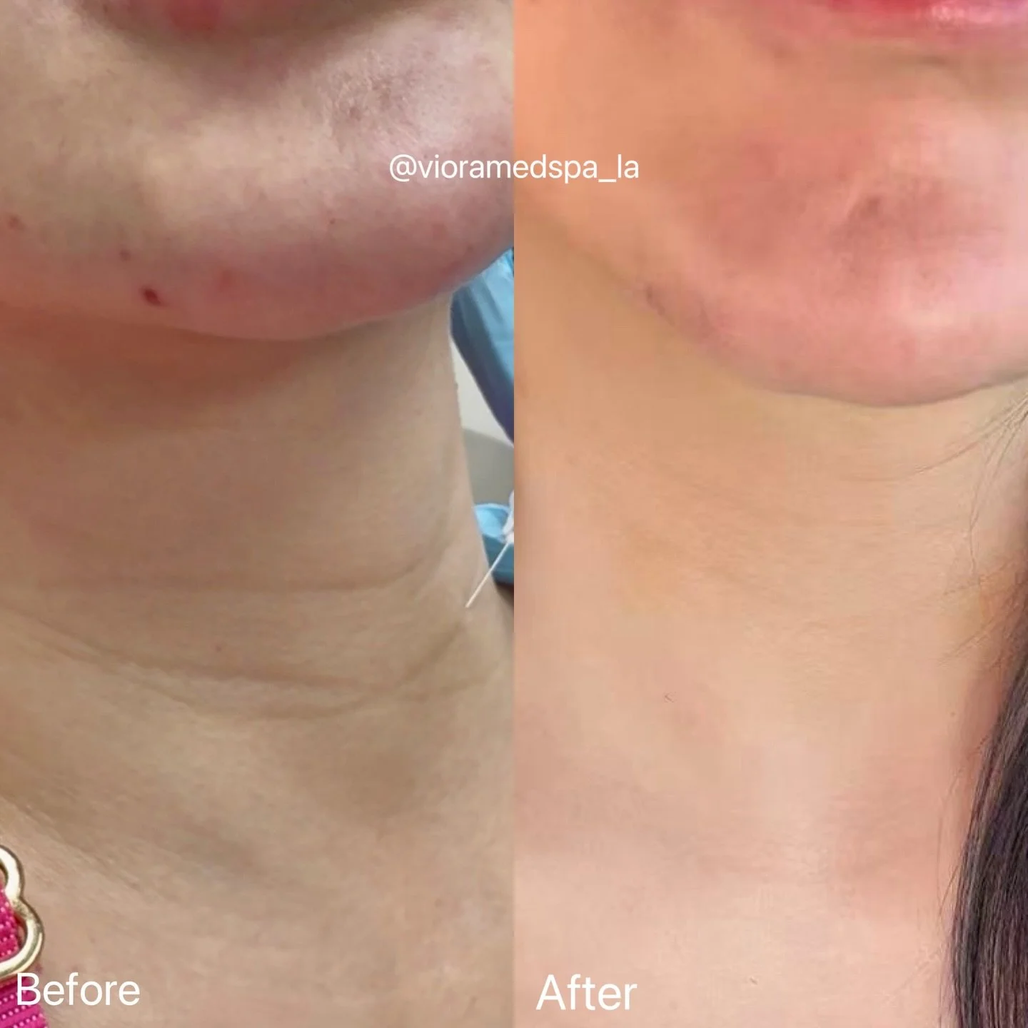 ✨ Before &amp; After ✨ Our client treated her neck with Juvelook &amp; Skintox ($699 combo) and the results speak for themselves! 💉 Juvelook boosts collagen for firmer skin, while 💧 Skintox smooths lines by relaxing muscles.

She&rsquo;s thrilled t