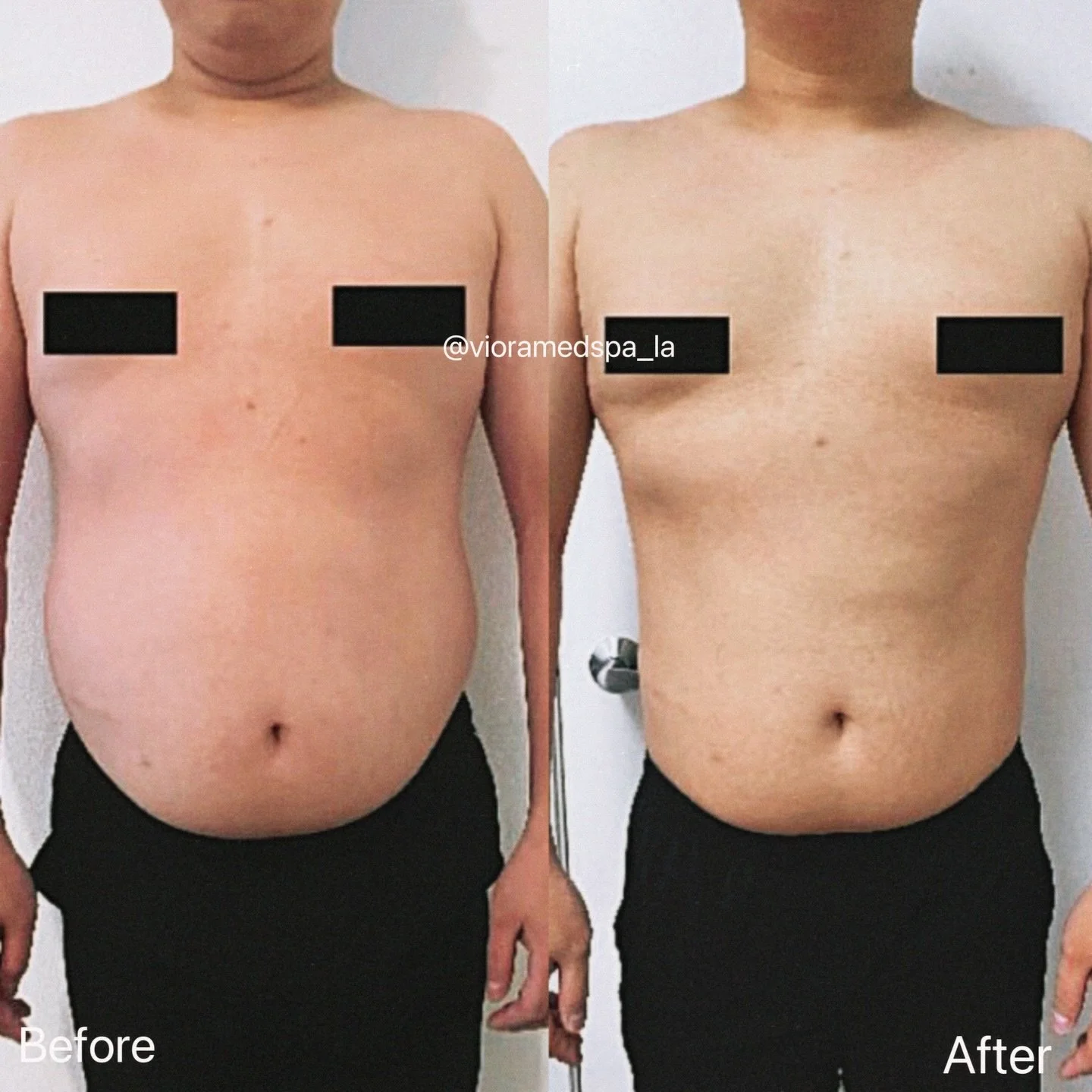 Discover how simple lifestyle changes can help you become a healthier, happier version of yourself! By influencing appetite-related receptors in the brain, this treatment helps reduce hunger and curb cravings for sweet and fatty foods- supporting sus