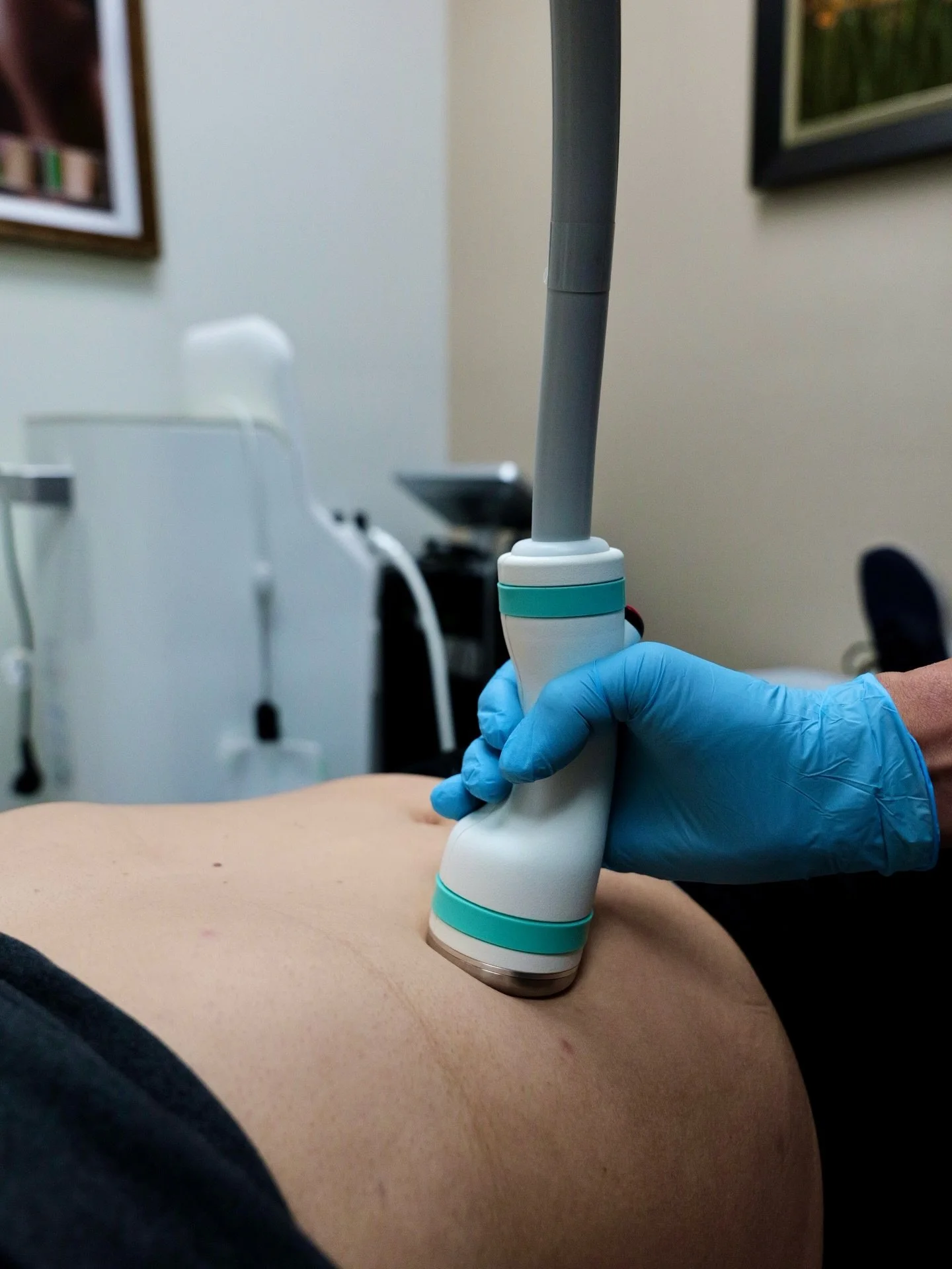 ONDA Coolwaves technology helps reduce stubborn fat, smooth cellulite, and improve skin firmness &mdash; all without surgery.

✨ Limited-time ONDA package specials now available.

📍 Viora Med Spa LA
📩 DM us to schedule your consultation.

⸻

바디 컨투어