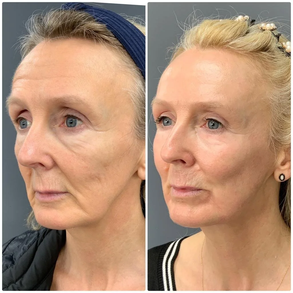 Brighter. Firmer. Lifted. ✨

NEOGEN targets dullness, loose skin, and fine lines&mdash;boosting radiance, restoring volume, refining texture, and delivering a visible lift.

Skin that looks clear, smooth, and renewed.
 Book your consultation today.

