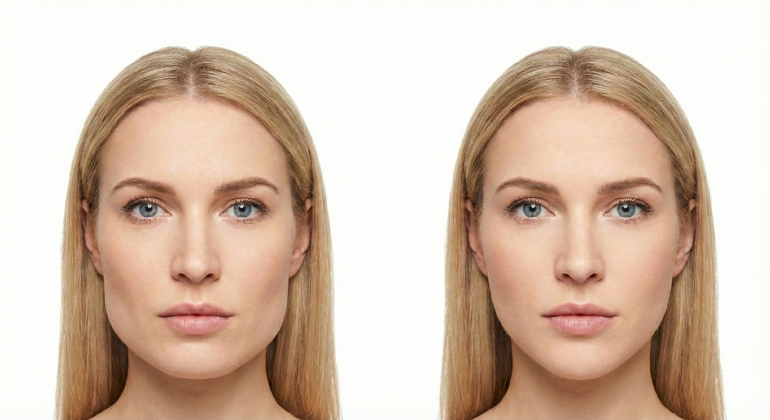 Masseter botox manchester