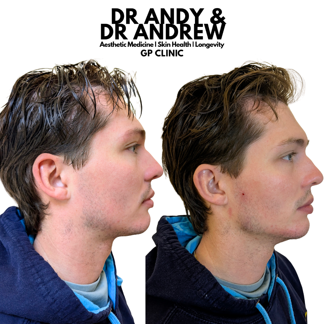 mens jawline filler manchester