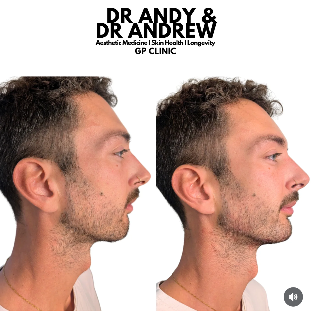 mens jawline filler manchester