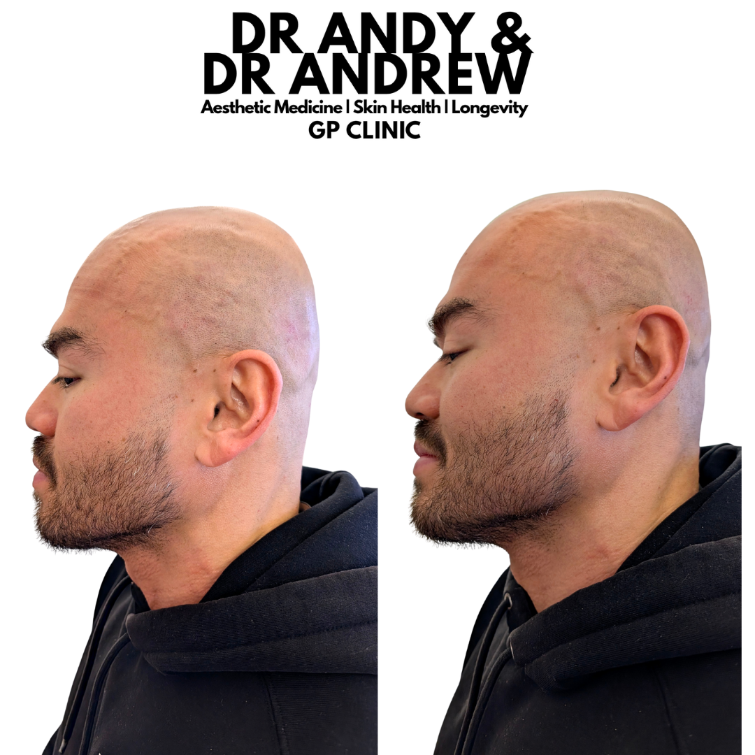 mens jawline filler manchester