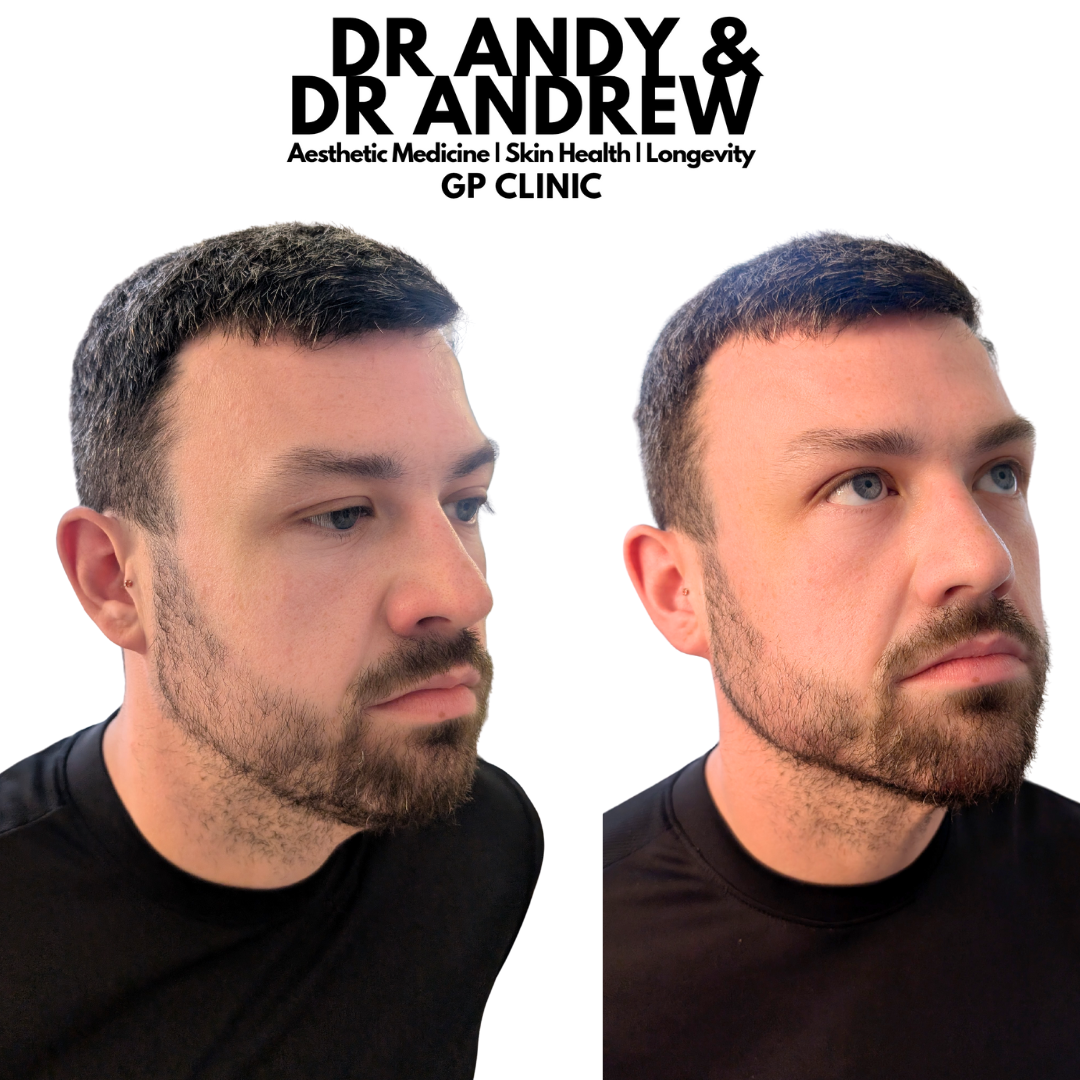 mens jawline filler manchester