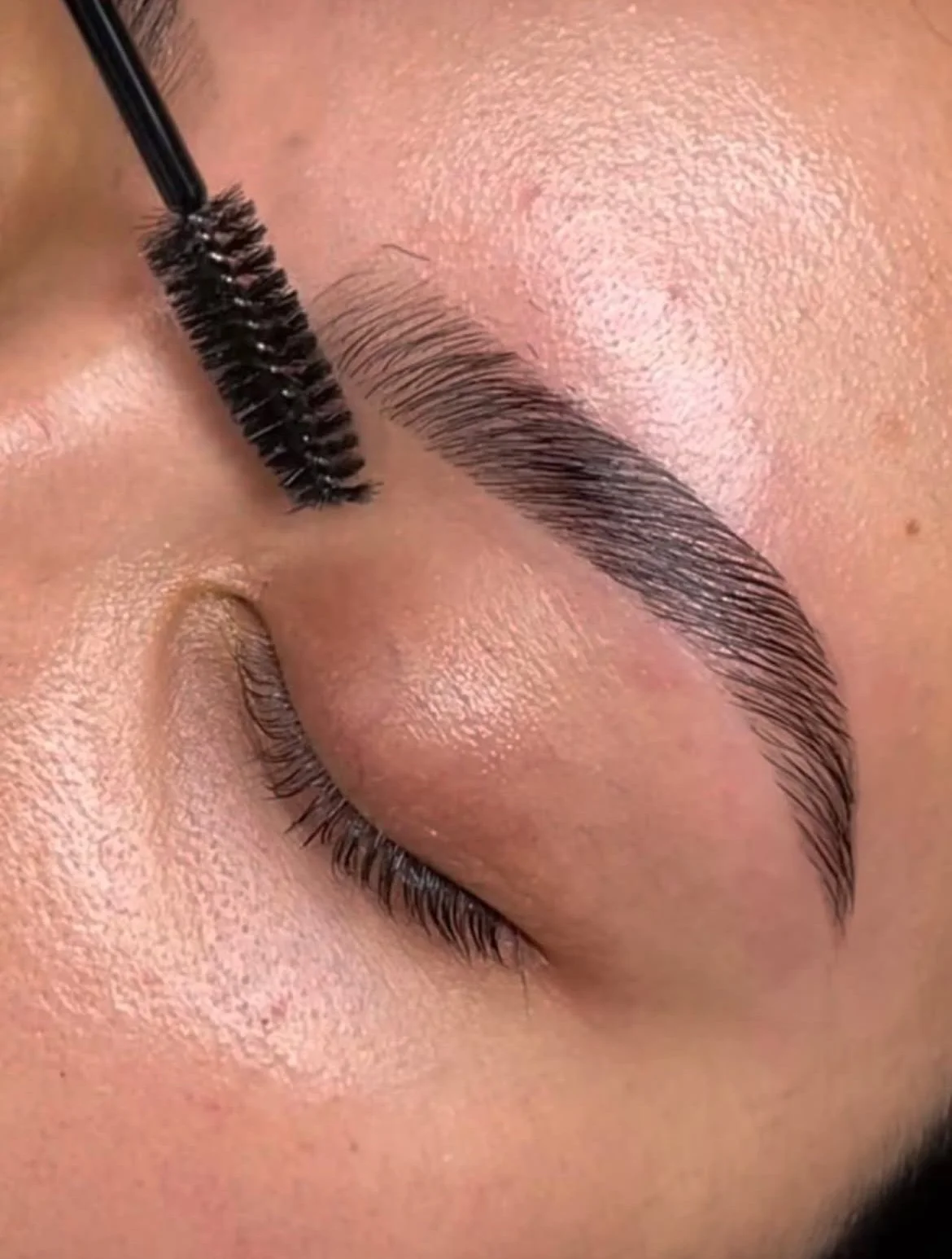 Brow lift réalisé à Marseille chez Onyx Studio pour restructurer le regard