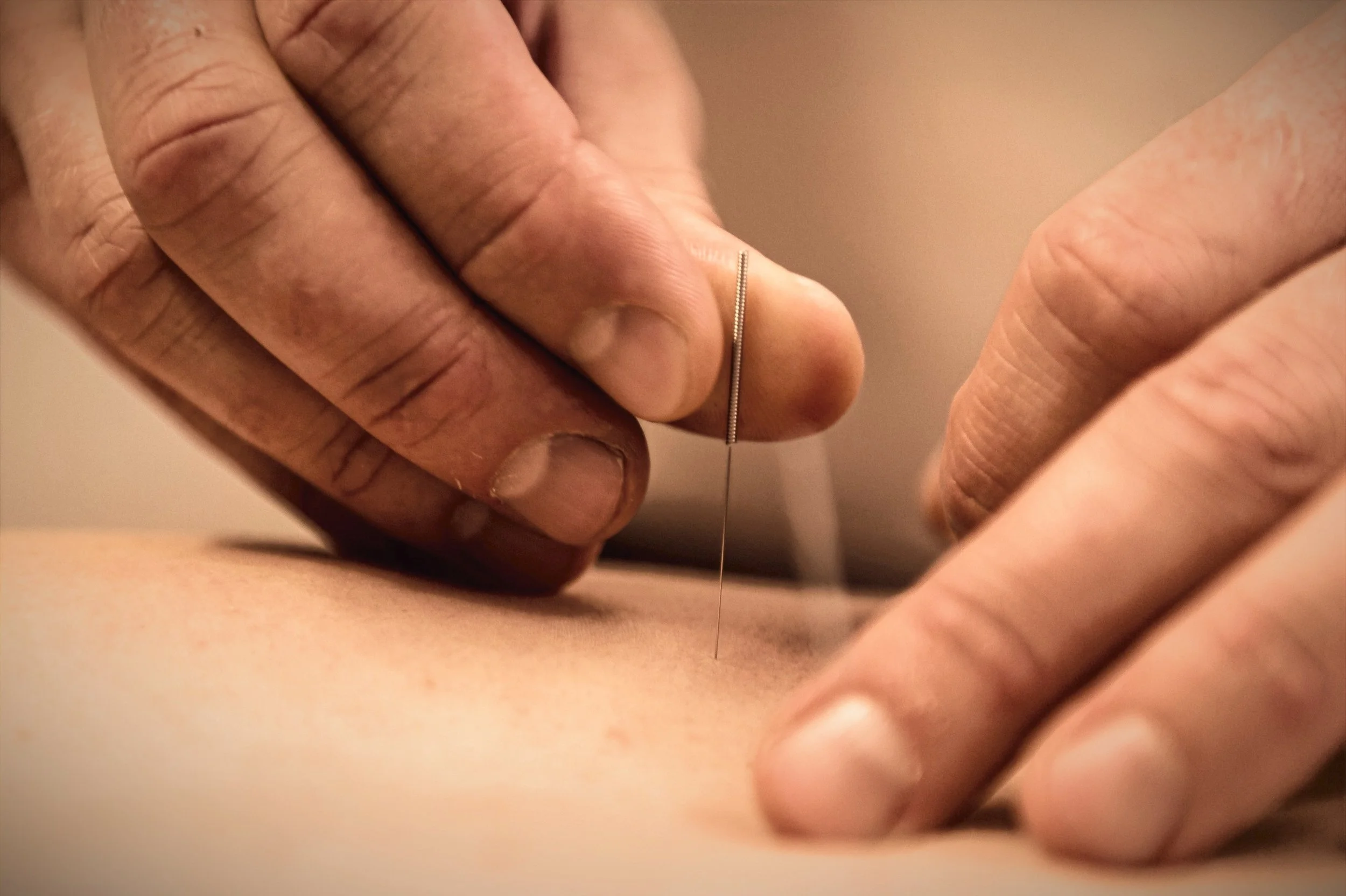 En person som ger akupunktur.