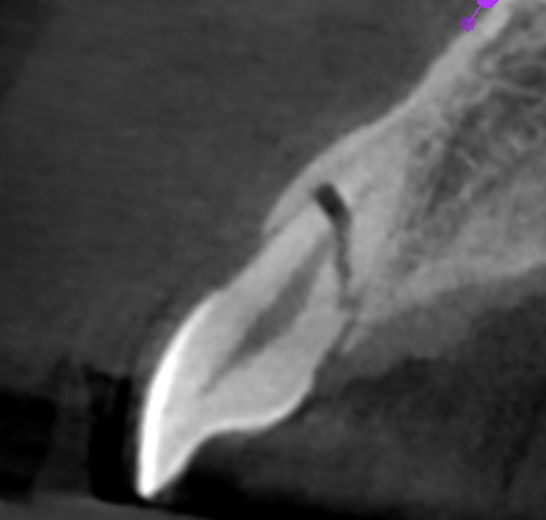 paleta rota Bilbao diente roto