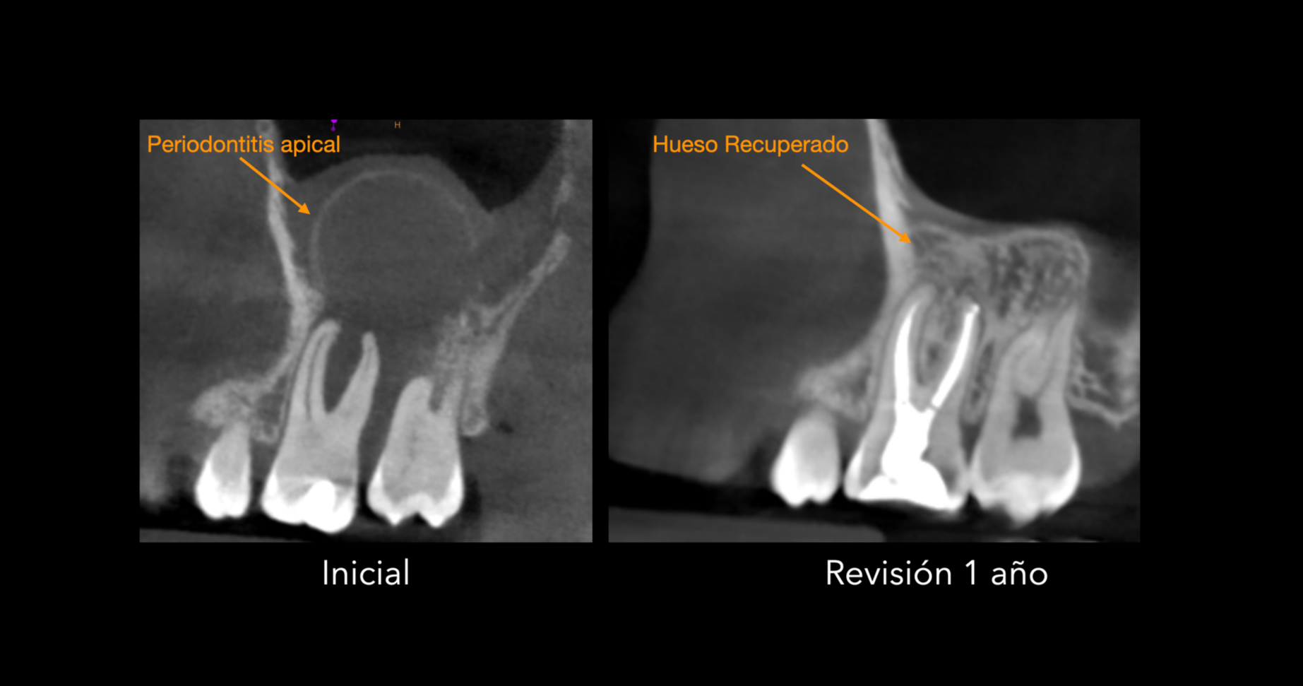 salvar diente especialista endodoncia