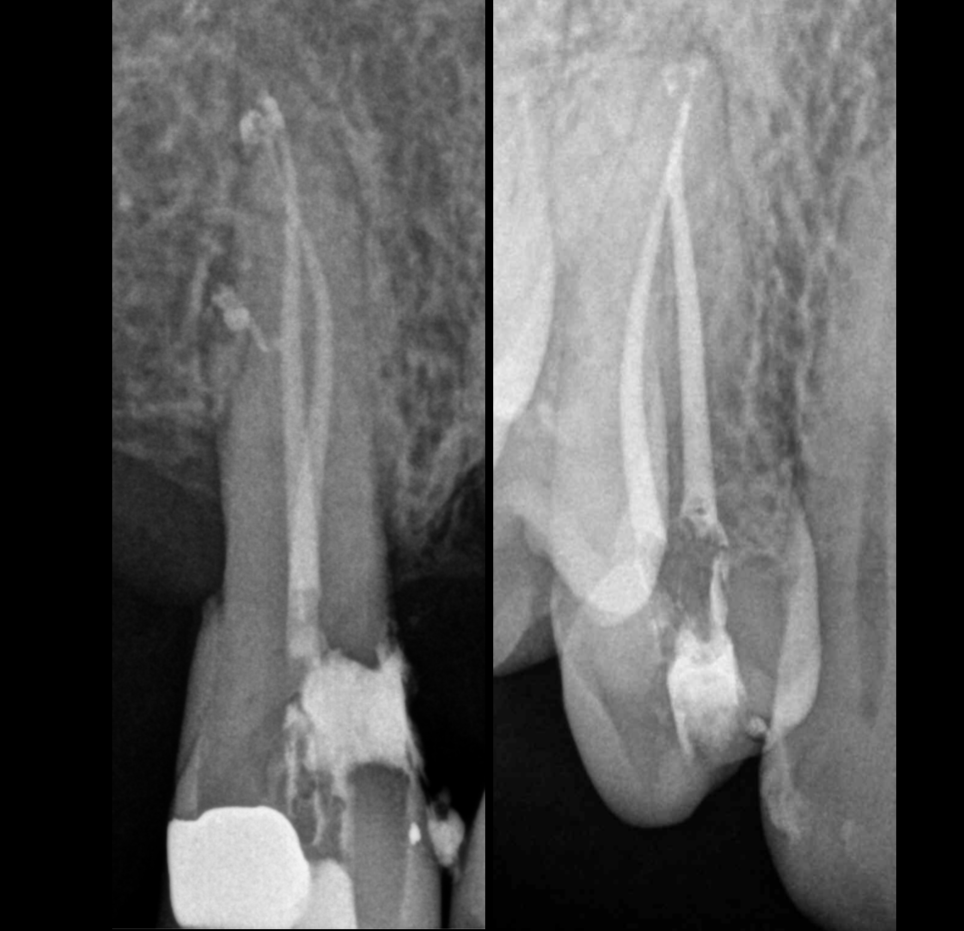 endodoncia desvitalizar Bilbao quiste dental 