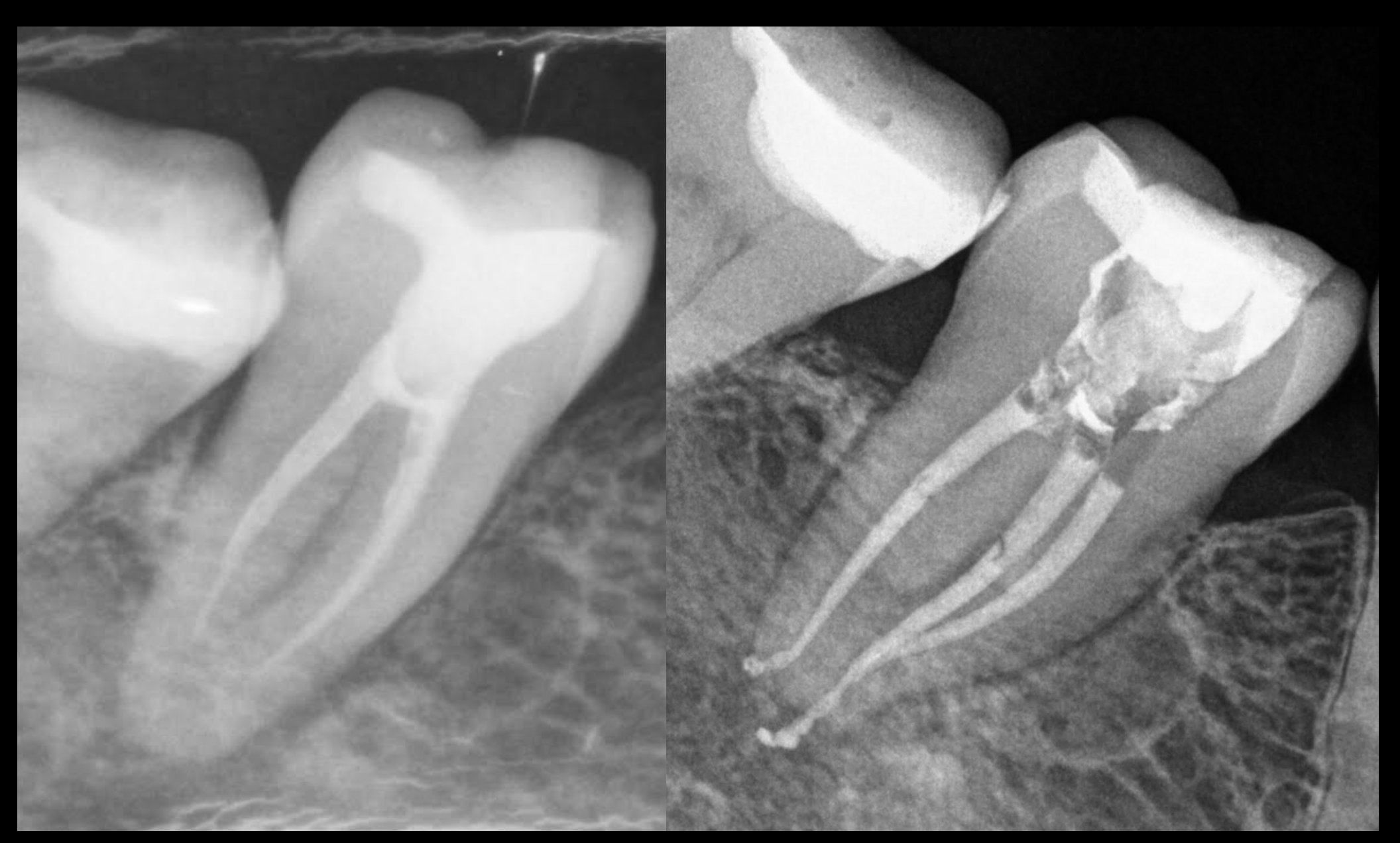 endodoncia Bilbao especialista microscopio