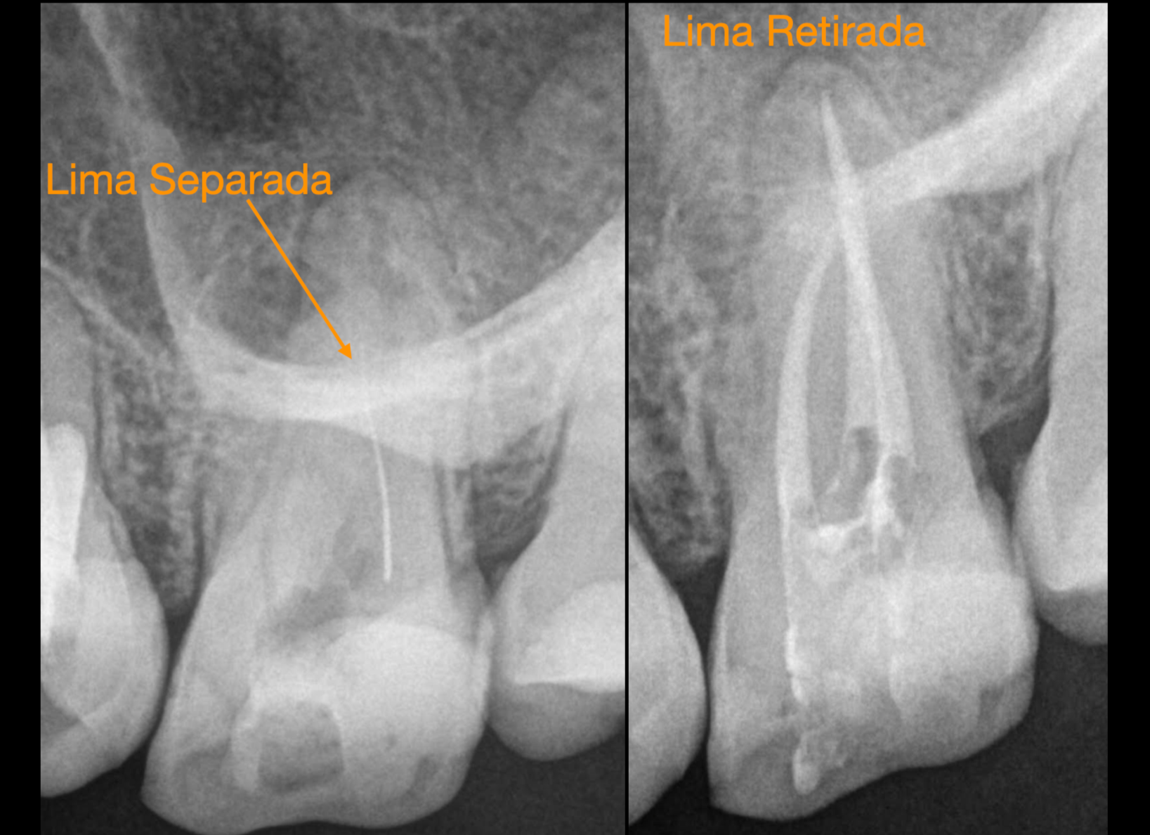 lima rota Bilbao sacar lima rota