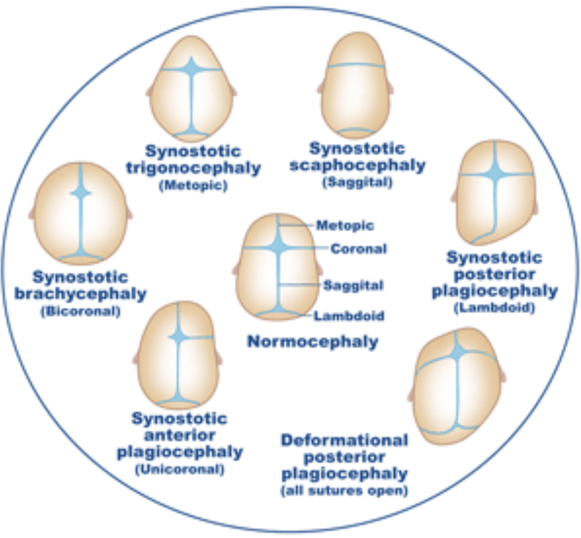 Diagram of different types of cephalic presentations with classifications for fetal head positions in labor, including synostotic, metopic, sagittal, bicoronal, lambdoid, anterior and posterior plagiocaphaly, normocephaly, and deformed posteror plagiocaphaly.