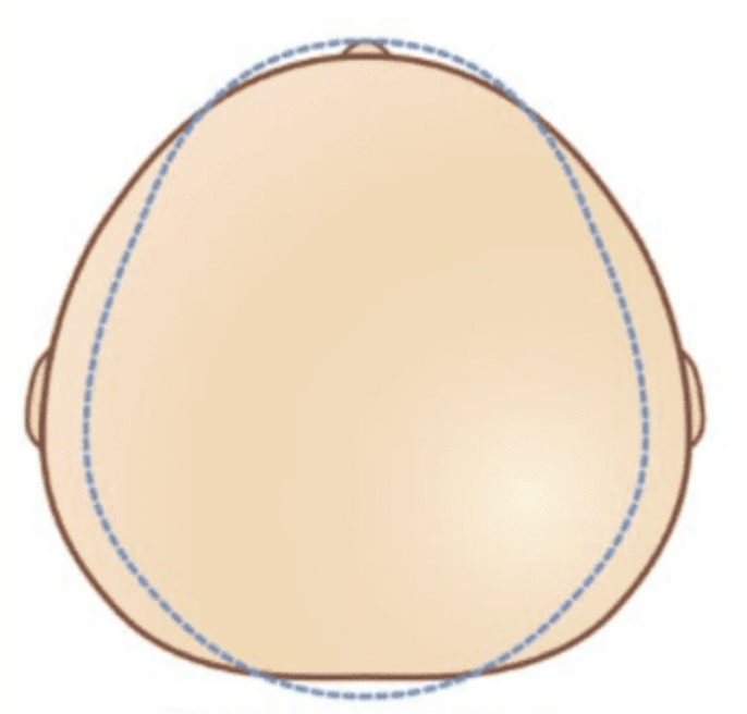 Top view of a human head illustration showing the scalp with dotted lines indicating areas for hair transplant.