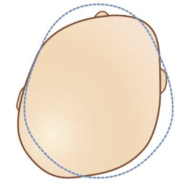 A simplified illustration of a person's head seen from above, showing hairline, ears, and the top of the scalp.