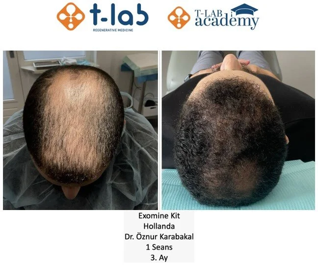 Exosome Rich Plasma (1 session) results after 3 months