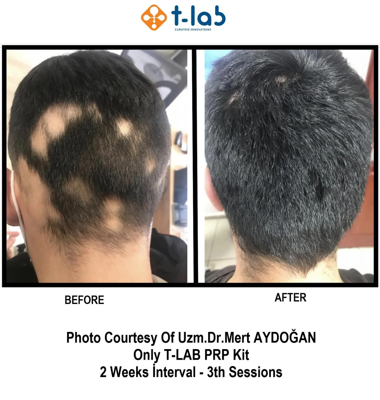 Platelets Rich Plasma 3 sessions with 2 weeks intervals