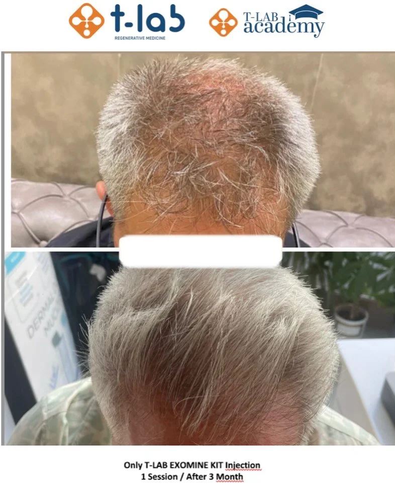 Exosome Rich Plasma