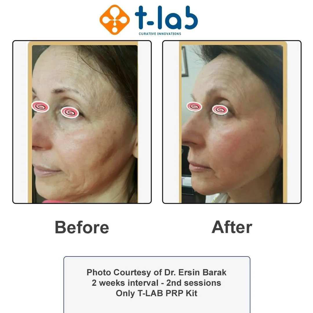 Platelets Rich Plasma for skin rejuvenation 2 sessions with 2 weeks intervals