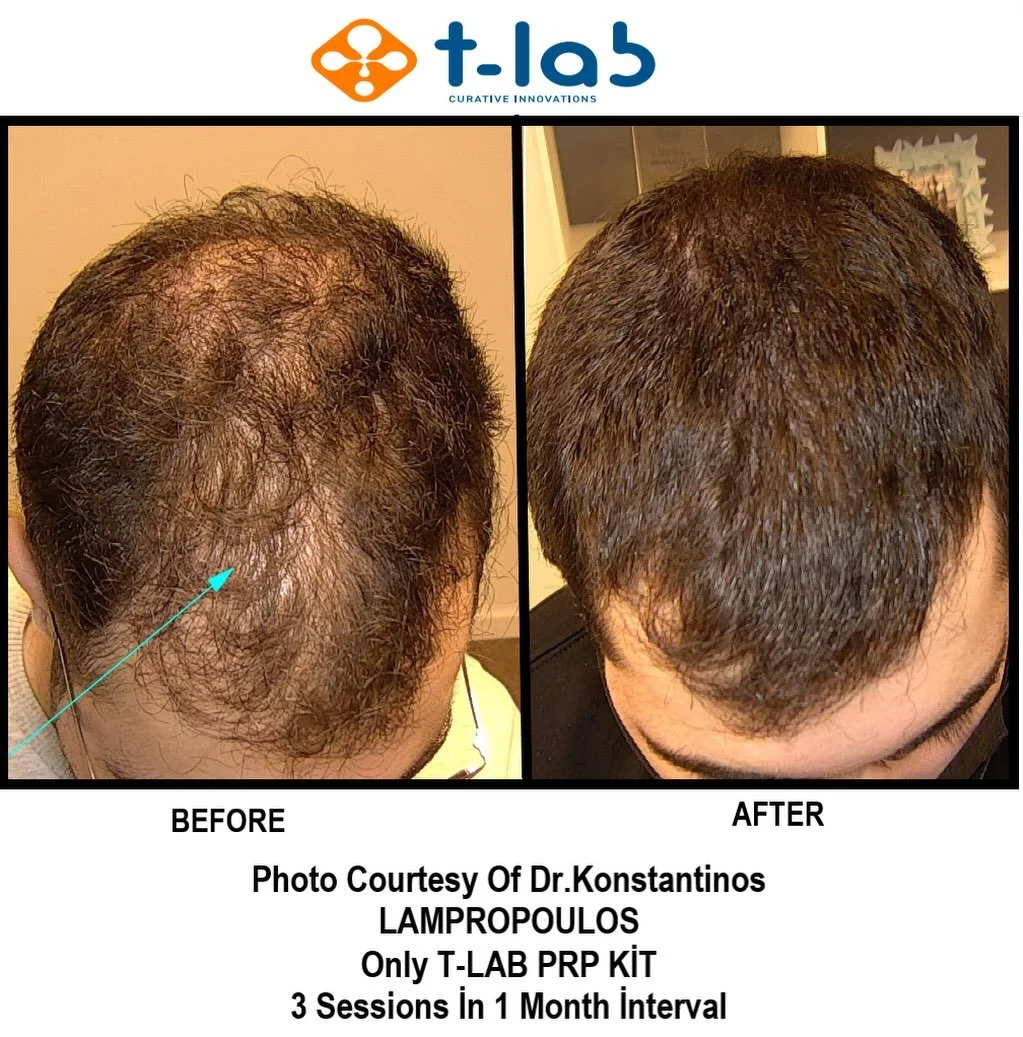 Platelets Rich Plasma (PRP) for hair loss treatment