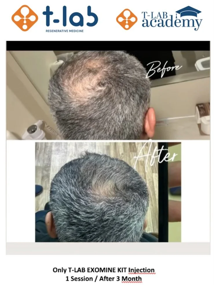 Exosome Rich Plasma