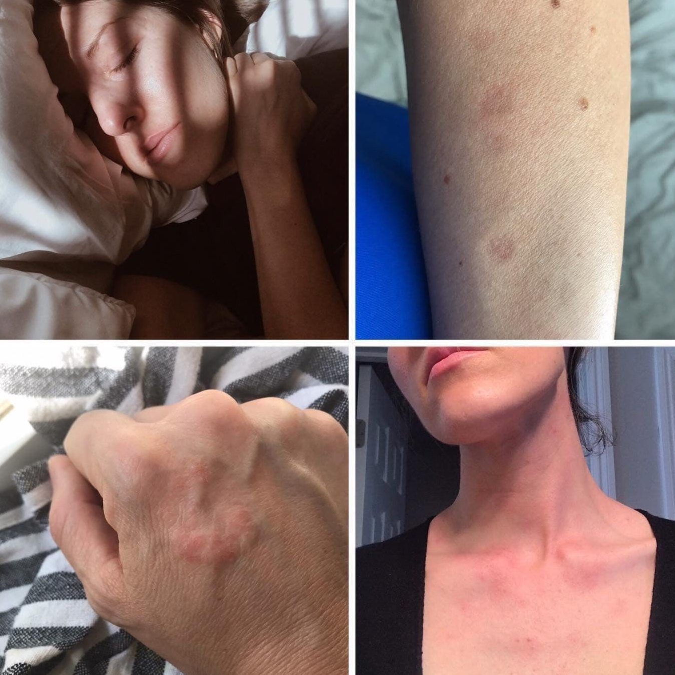 Image of before pictures of Lupus SLE