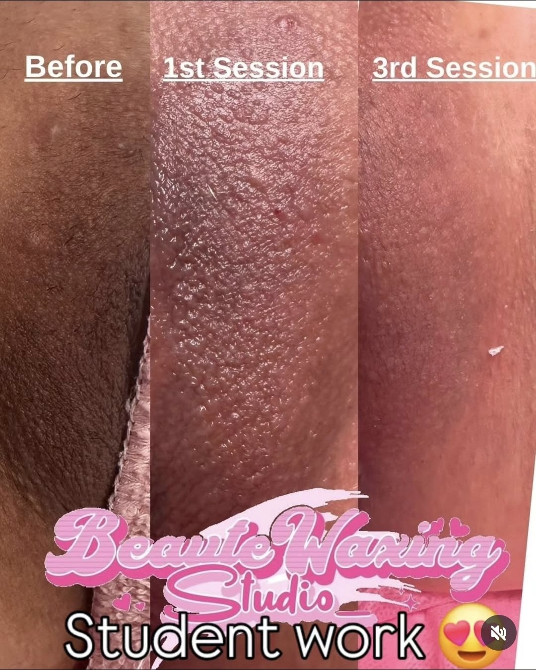Before and after results showing improvement in skin tone after professional Brazilian waxing and advanced skin lightening treatment.