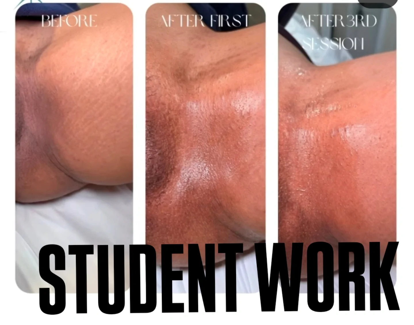 Before and after results showing improvement in skin tone after professional Brazilian waxing and advanced skin lightening treatment.