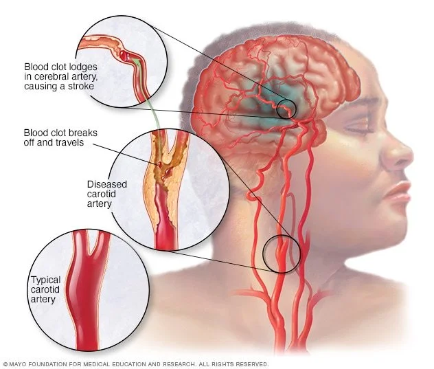 Ischemic and Other Strokes
