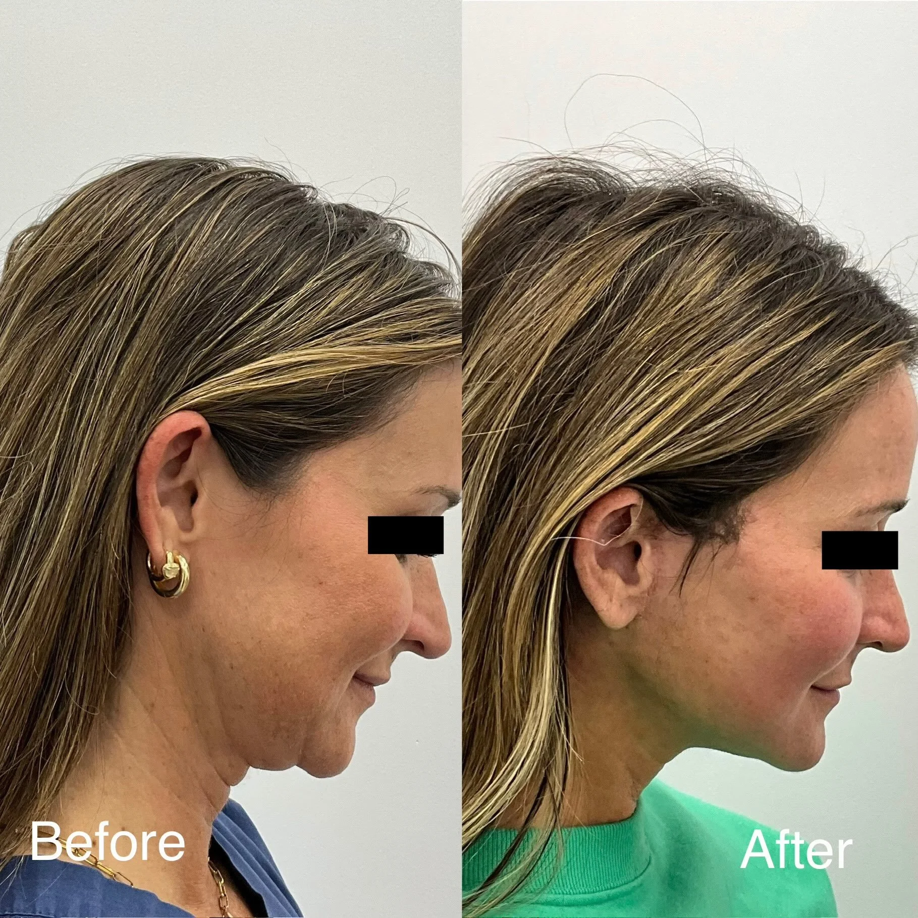 Just one month after a Preservation Deep Plane Facelift + CO2 Laser Resurfacing of the face, neck, and chest, and loving these early results!
This patient wanted to take a proactive approach to facial aging by addressing early skin laxity of the lowe