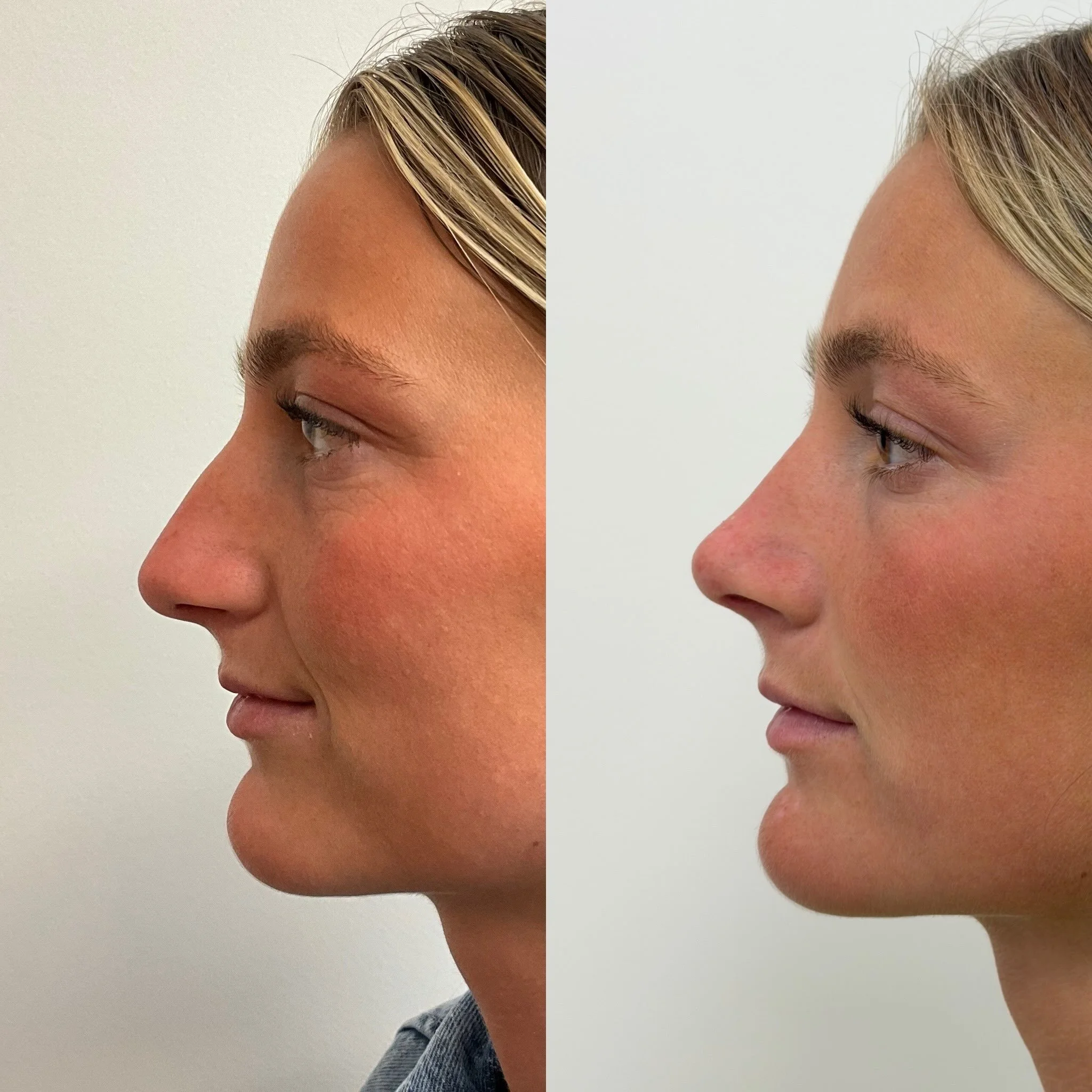 Rhinoplasty - 6 months out. This amazing patient never felt like her nose quite matched her face. We addressed both the shape and structure, including a septoplasty to help with airflow and grafting to support the tip. It is an honor to work with pat