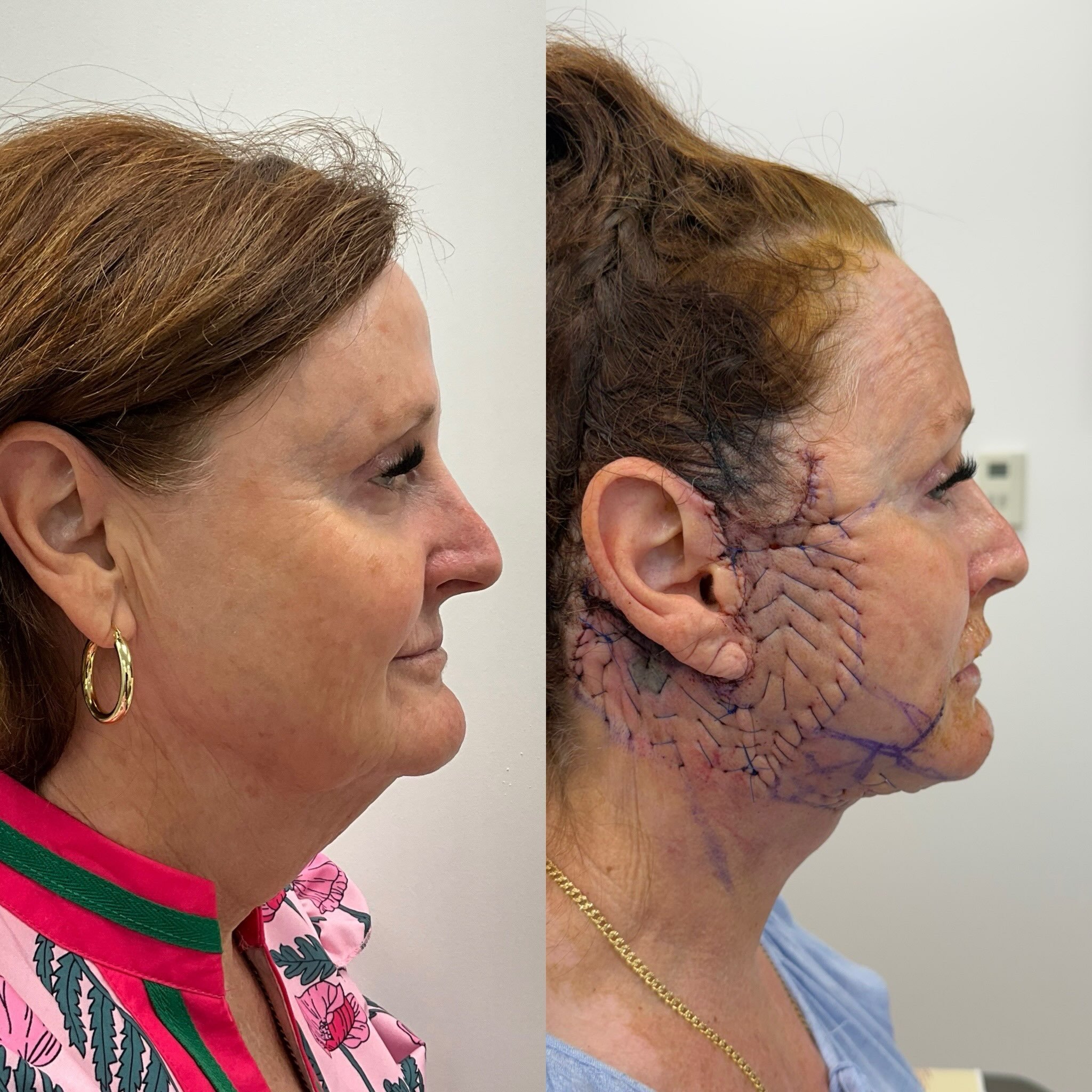 Trusting the process: 1-Day postoperative from Deep Plane Face &amp; Neck Lift with Peri-oral CO2 laser

2 weeks after Deep Plane Face &amp; Neck Lift with Peri-oral CO2 laser

Early results and more healing ahead, but already looking amazing and rej