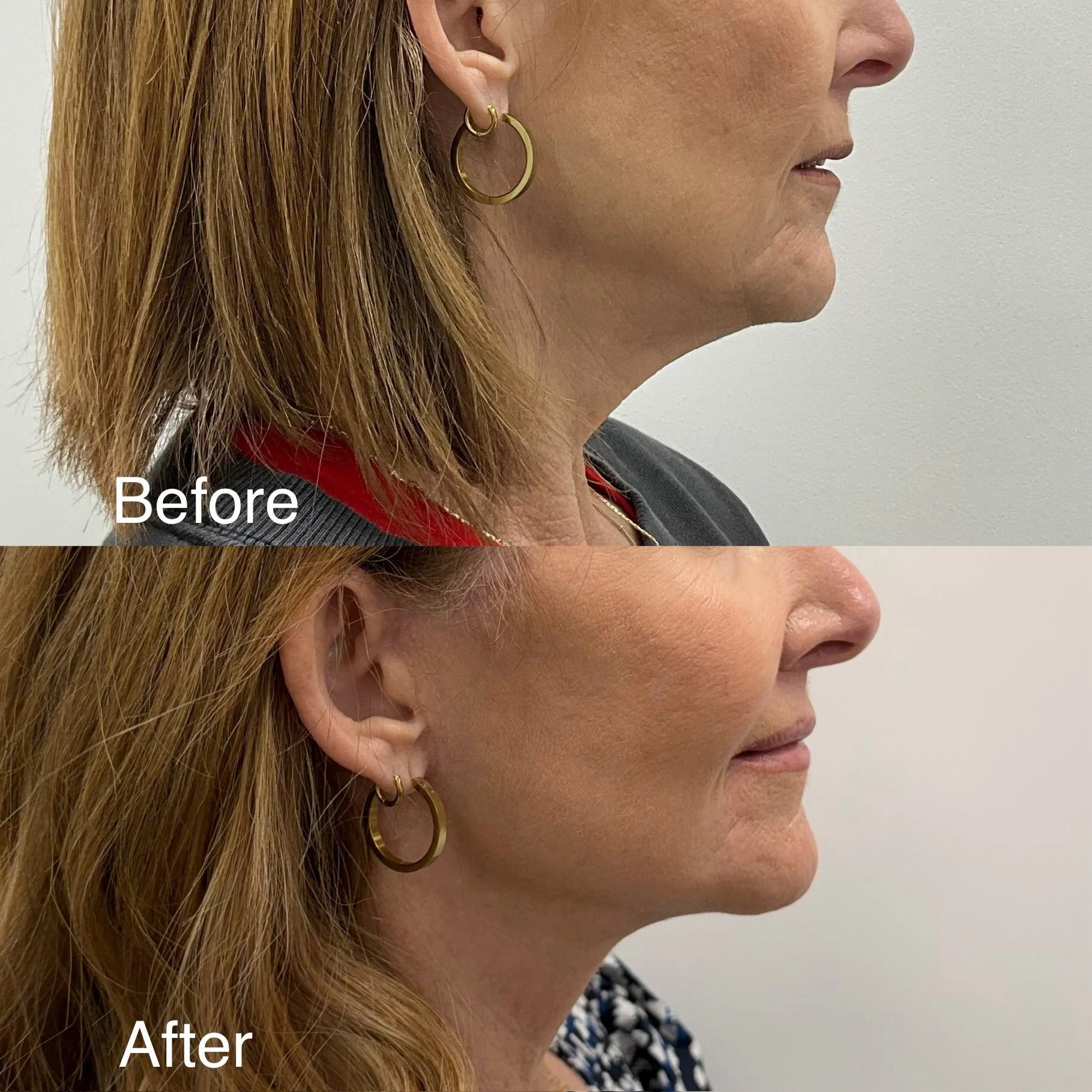 3 months out for&nbsp;this amazing patient in her 60s. Deep plane face &amp; neck lift, Upper Lip lift, CO2 Laser. 

In her initial consultation, she was upfront about her biggest concern: not wanting to look overdone. What she wanted was subtle, nat