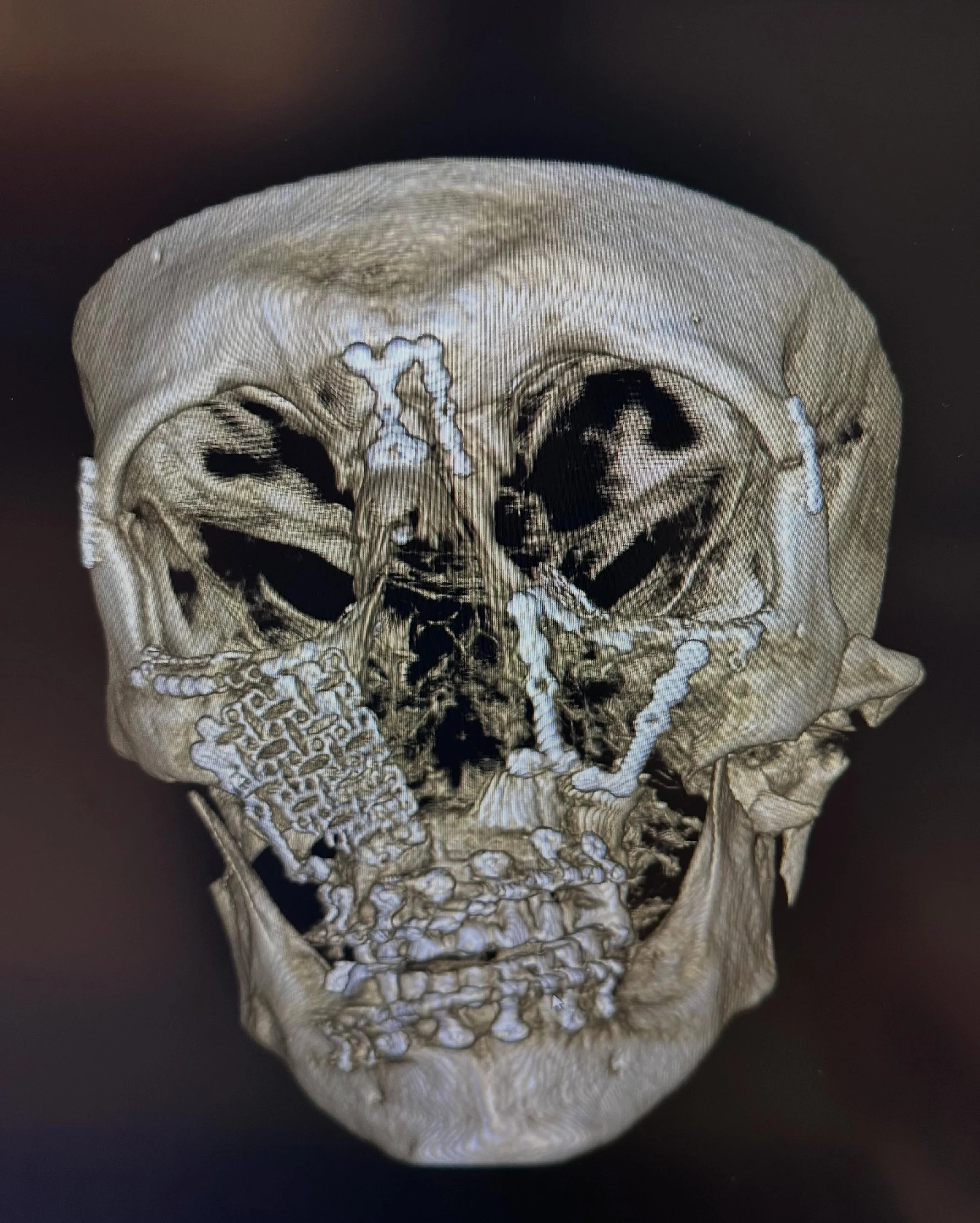 Remember to always wear a seatbelt! Facial Reconstructive surgery is always a challenging puzzle to solve! Thanks to @strykercmf for their medical modeling technology.