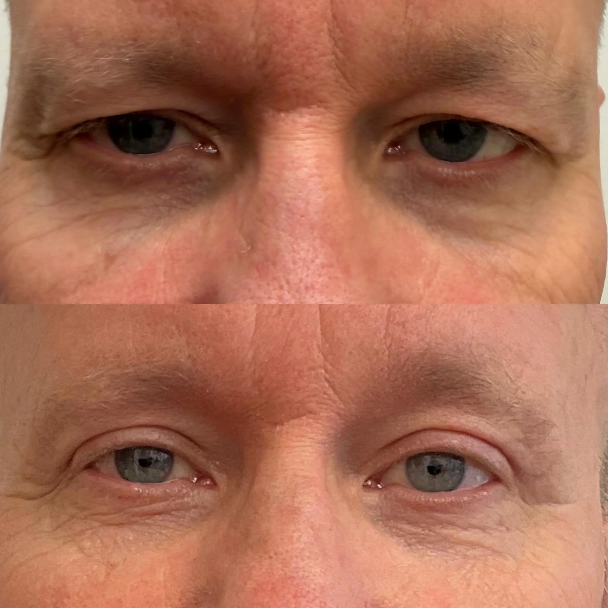 Upper Eyelid Blepharoplasty &mdash; restoring a more refreshed, youthful appearance while improving visual obstruction caused by excess upper eyelid skin. 

With aging, upper eyelid skin can contribute to a tired look and even interfere with vision. 