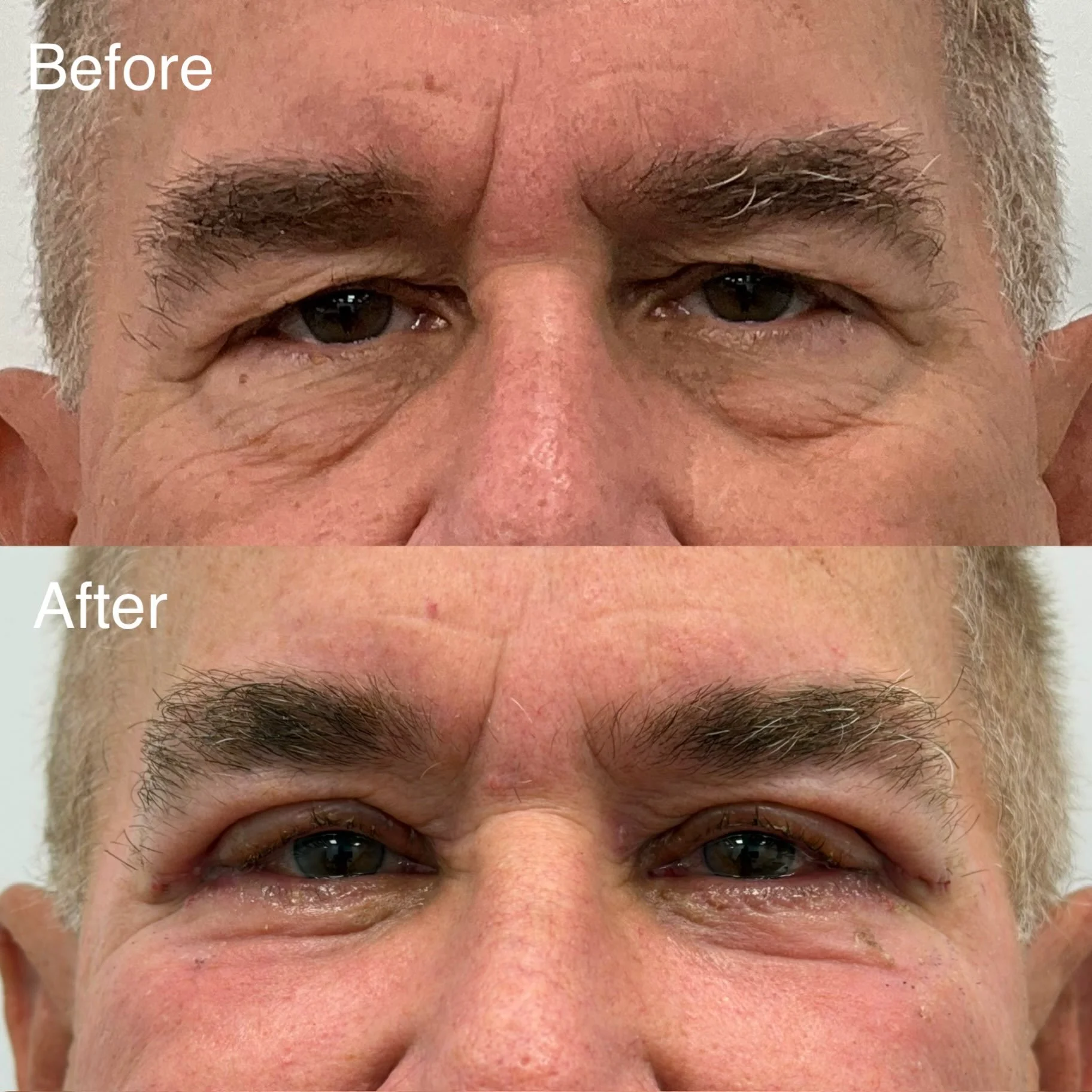 Only 1 week following an Upper and Lower Blepharoplasty, Lower Eyelid Skin Pinch, Lateral Canthopexy, and Periorbital CO2 Laser Resurfacing! It is great to see amazing early results, with healing that will continue to improve over the next several we