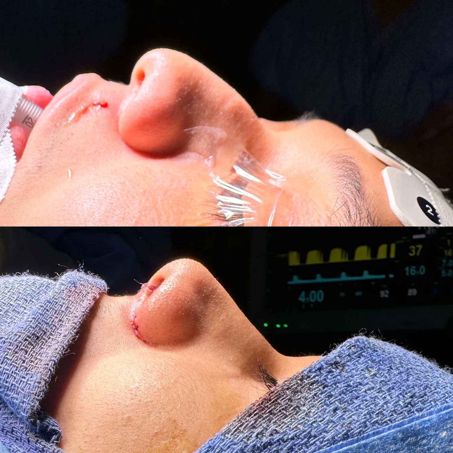 Rhinoplasty with Septoplasty before and after — This patient had a cleft lip and palate repaired as a young infant and child. Formal nasal reconstruction to establish natural shape as a young adult.
