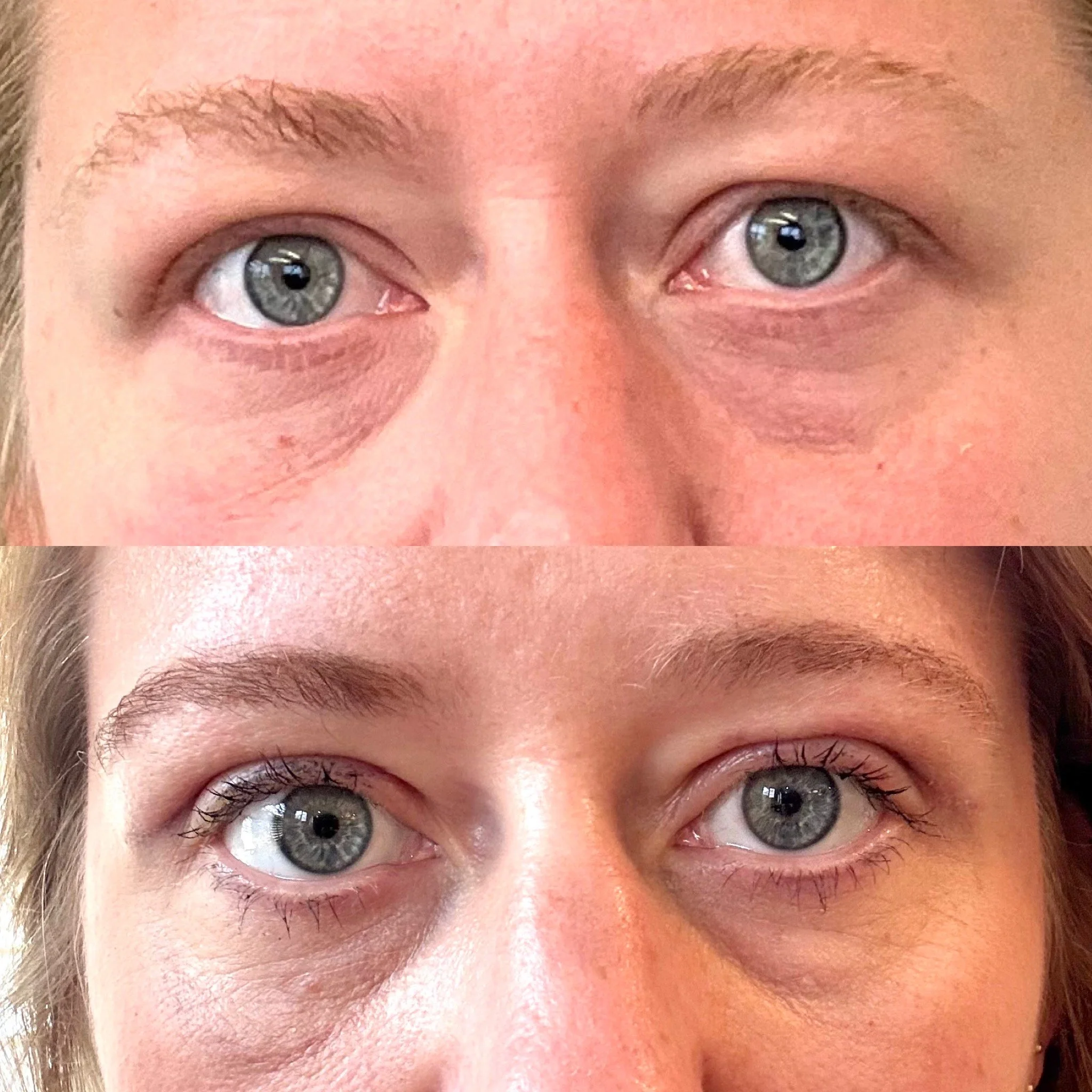 Upper Eyelid Blepharoplasty - Excess upper eyelid skin can add unwanted fullness to upper eyelids and facial expression. Hidden surgical scars beautiful result. 