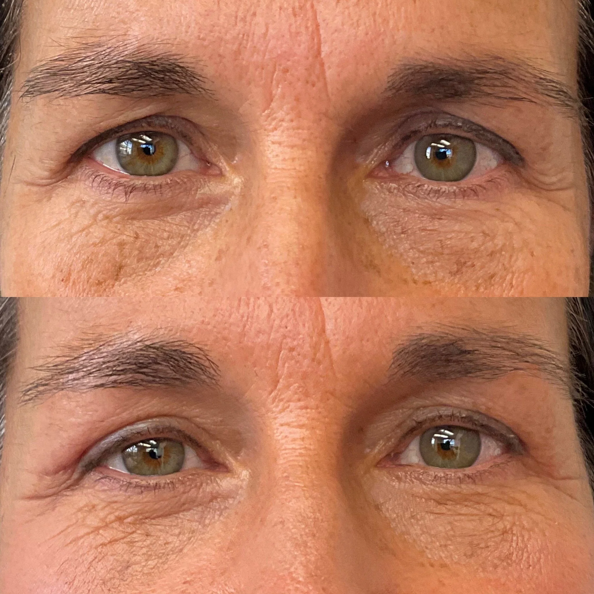 Upper Eyelid Blepharoplasty - This patient had a fantastic result with treatment of both excess skin aging along with asymmetry of the upper eyelids for a subtle youthful rejuvenation.