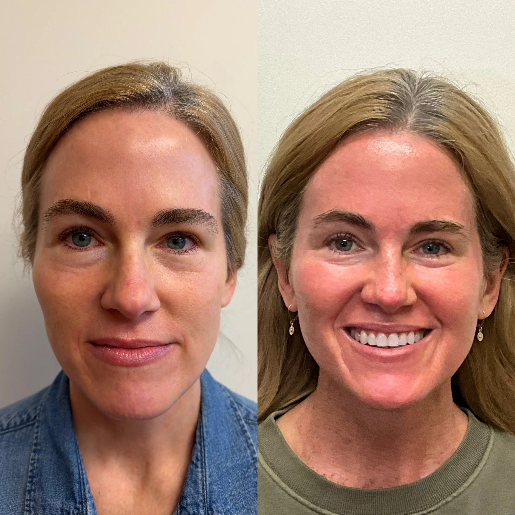 CO2 Laser Skin Resurfacing - Enhancement in skin tone, texture, quality, and collagen production.