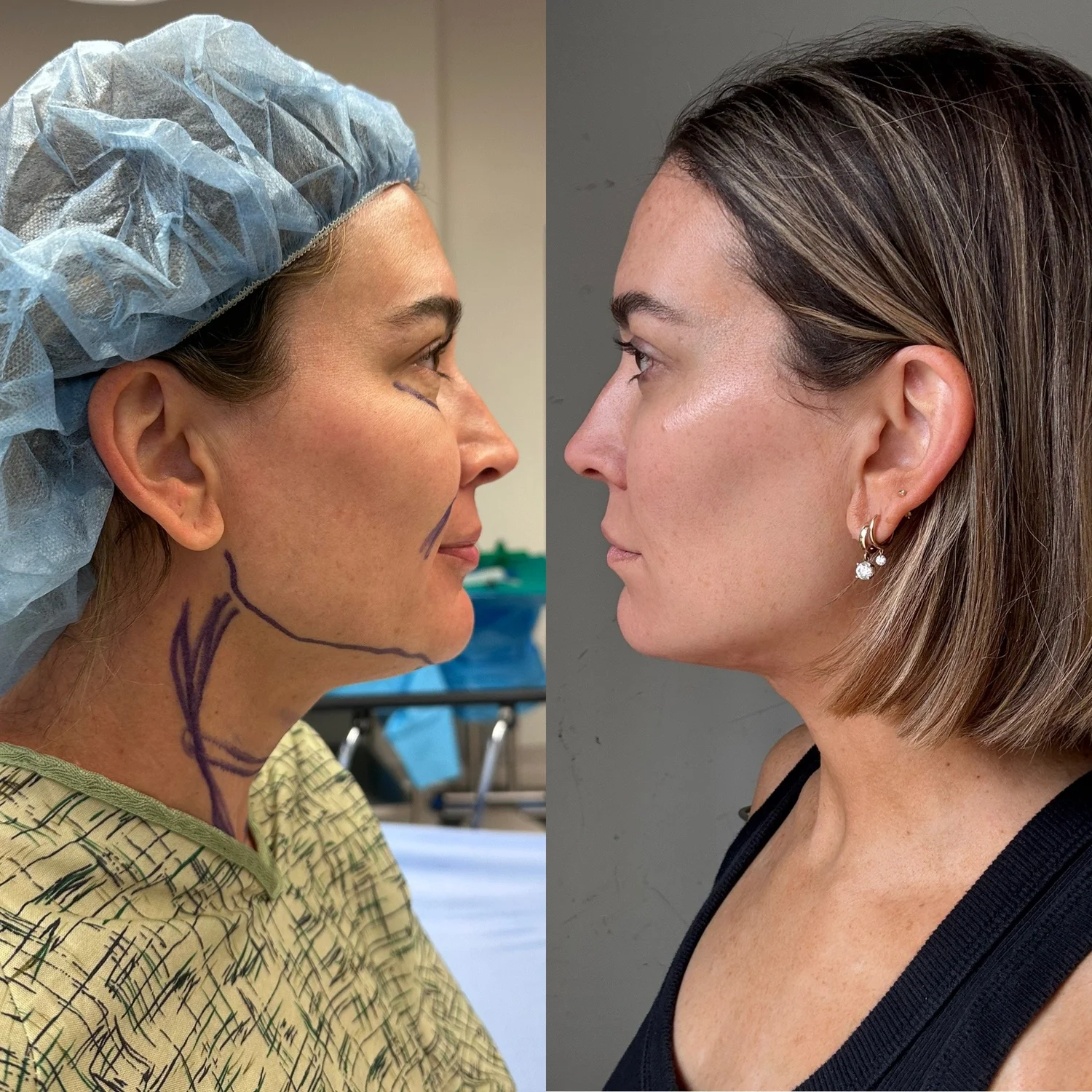 Deep Plane Neck Lift before and after — Restoring contour and establishing enhanced jawline definition with a natural result complimentary to the patient's face and neck aesthetic.