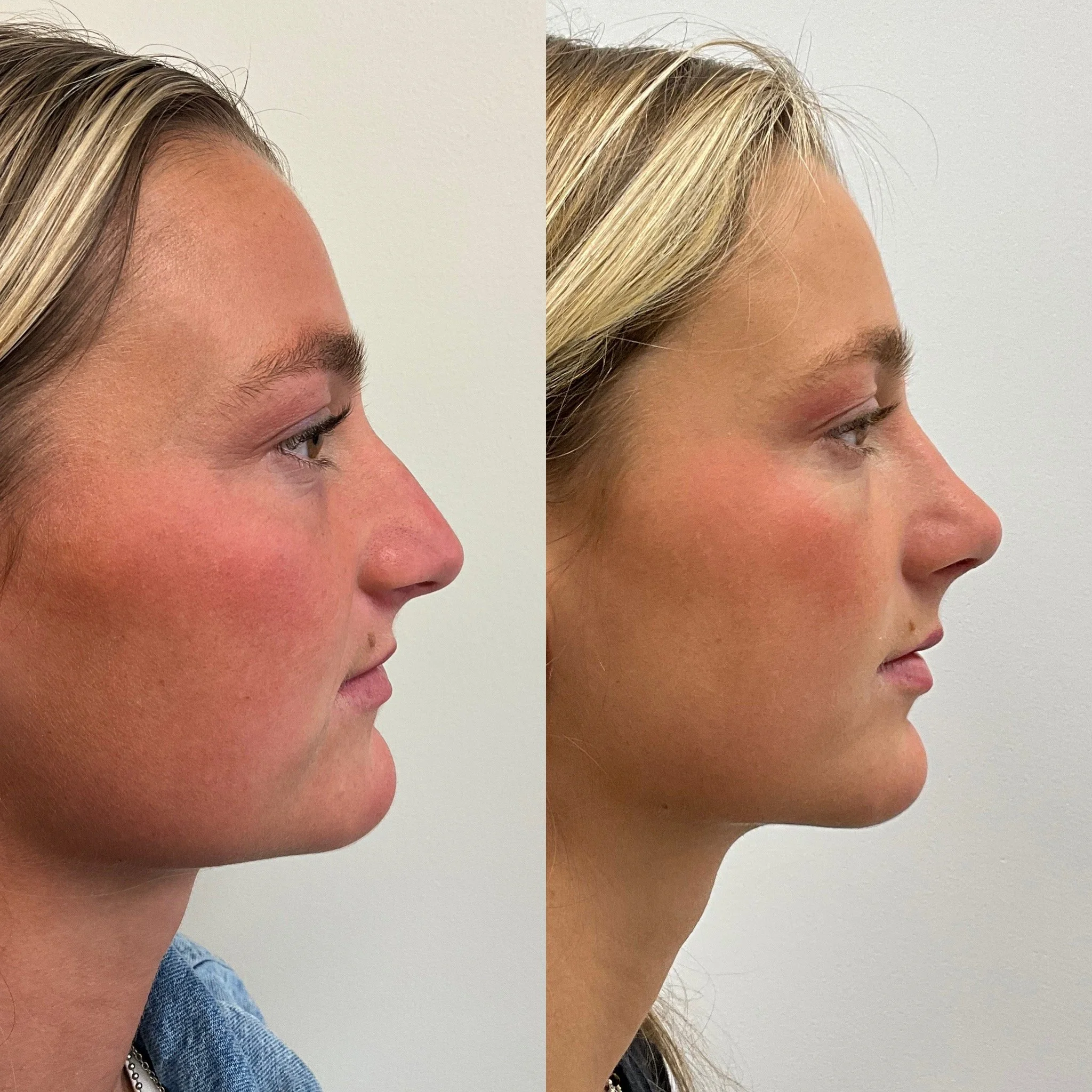 Rhinoplasty with Septoplasty and Internal Upper Lip Lift - A beautiful new contour to address her nasal tip and hump. Upper lip elevation and enhanced upper lip roll. 