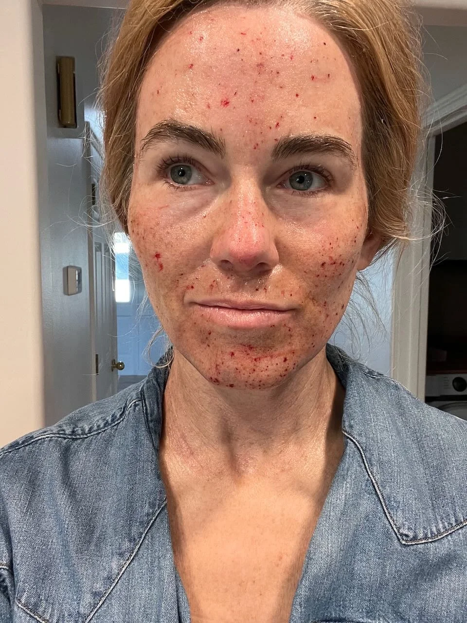 5 Hours After Procedure