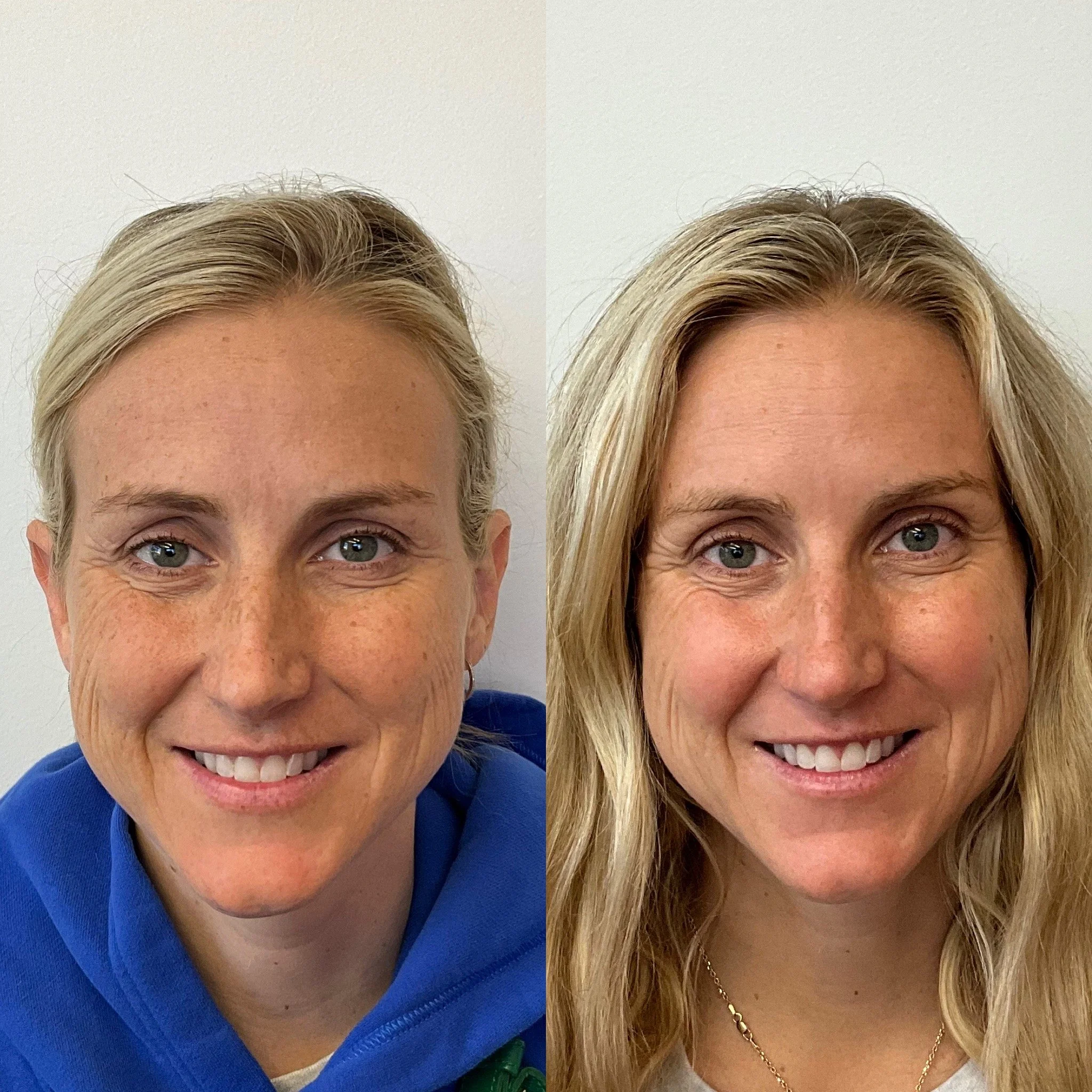 CO2 Laser Skin Resurfacing - Reduction in wrinkles and fine lines. Improved tone and texture.