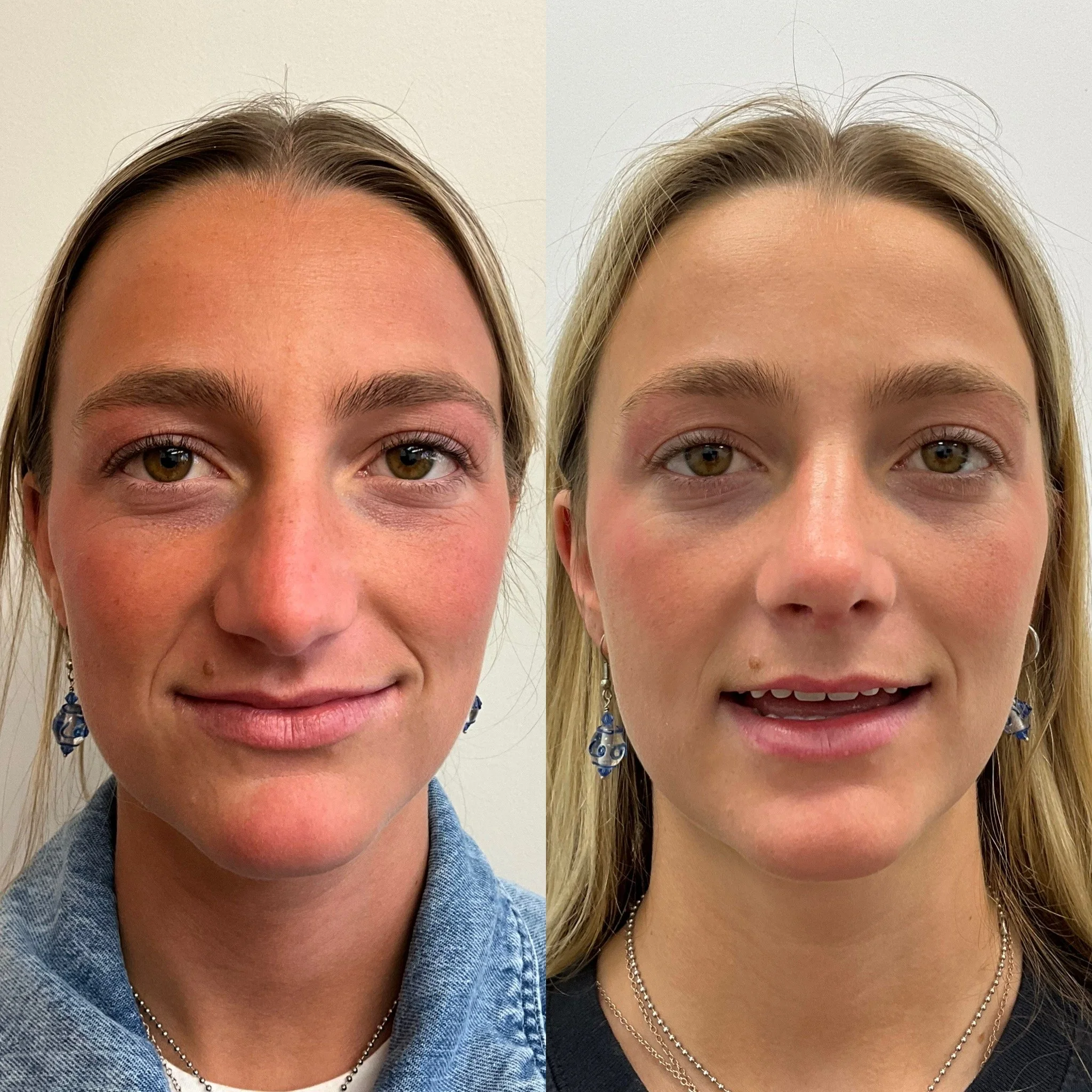 Rhinoplasty with Septoplasty and Internal Upper Lip lift. - This awesome patient desired improved aeshetic lines and contours of her nose and to address elevating her upper lip which did not have any tooth show in a resting position.  A natural and i