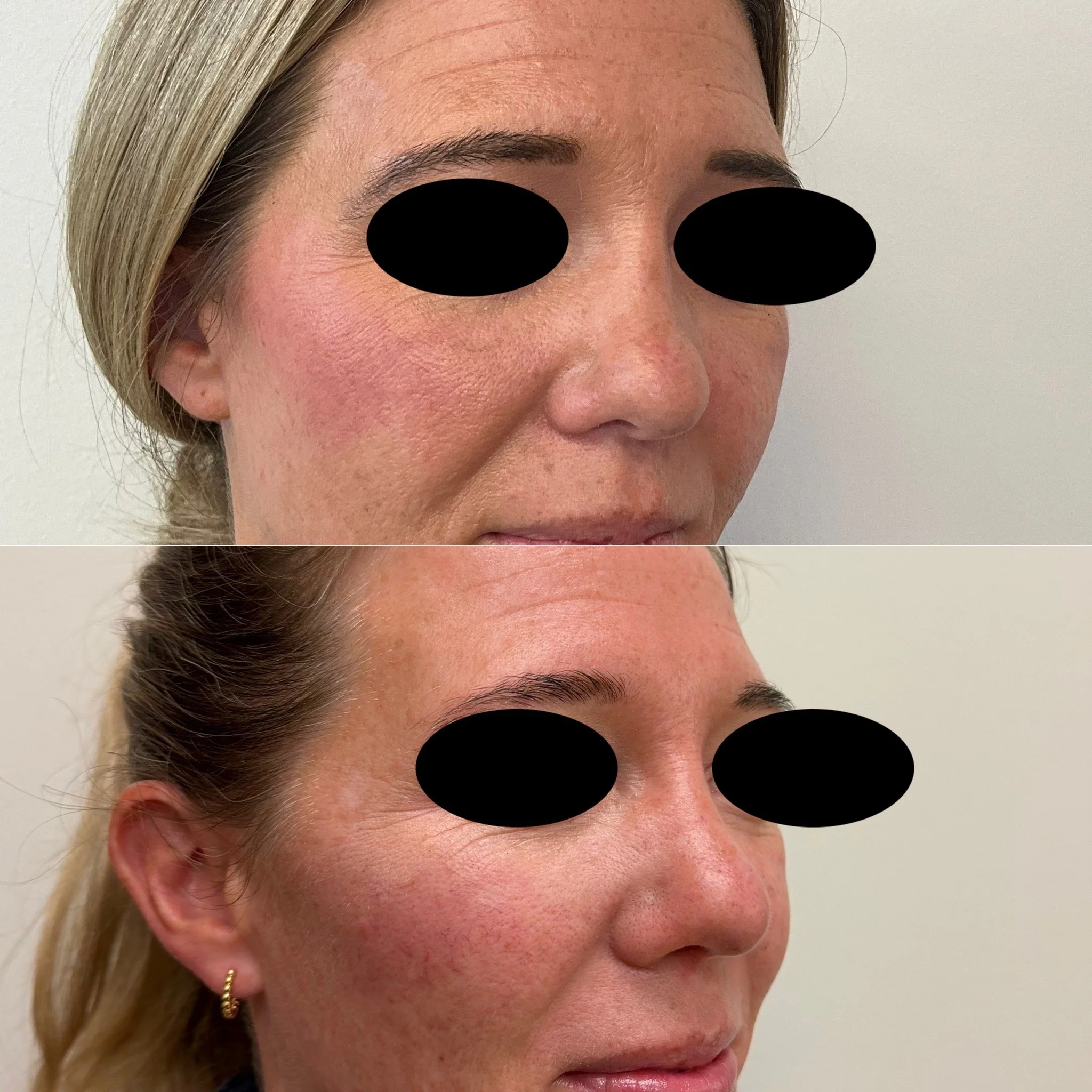 Rhinoplasty with Septoplasty - Improvement of nasal contour and dorsal aesthetic lines, notable improvement in tip support and narrowing of tip. 